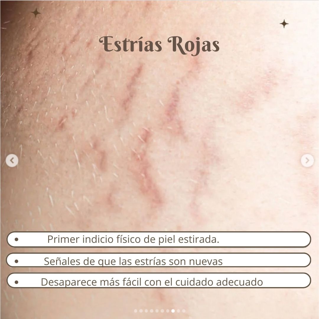 CIARA: Adiós a las estrías 001